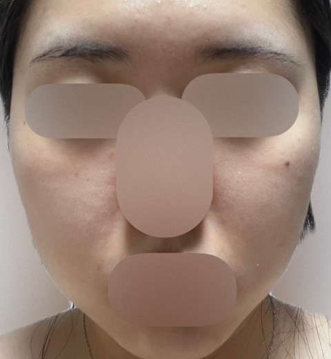 after photo: 윤곽주사, 얼굴지방분해주사
