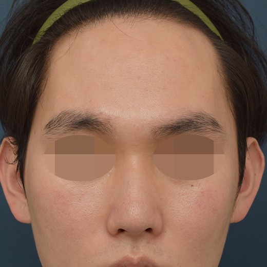 before photo: 콧대(자가조직), 코끝(자가연골)