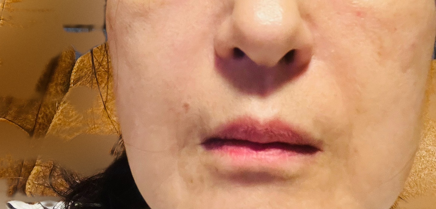 イタリア製 ♧ 口顎首のEx-voto ポテンツァ ダイヤモンドチップ（全顔300ショット）たるみ・引き締めに