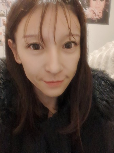 after photo: 糸リフト