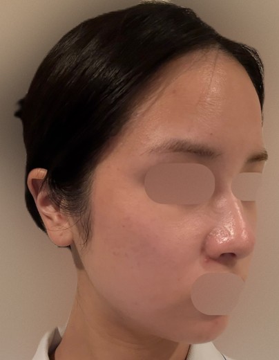 after photo: 水光注射