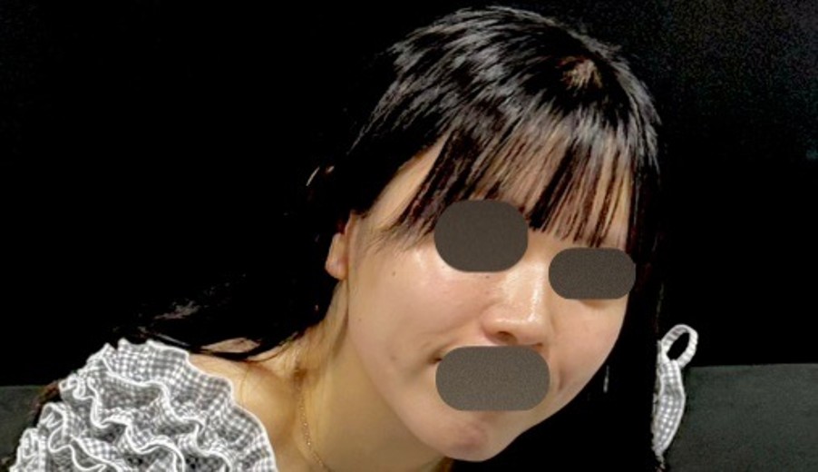 before photo: ほうれい線ヒアルロン酸