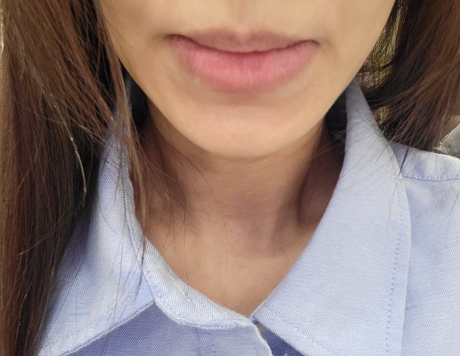 before photo: 입술축소술