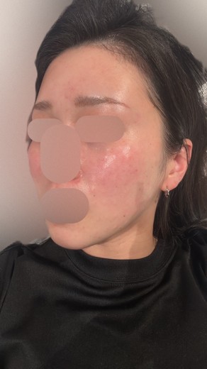 after photo: ララピール(LHAピーリング)