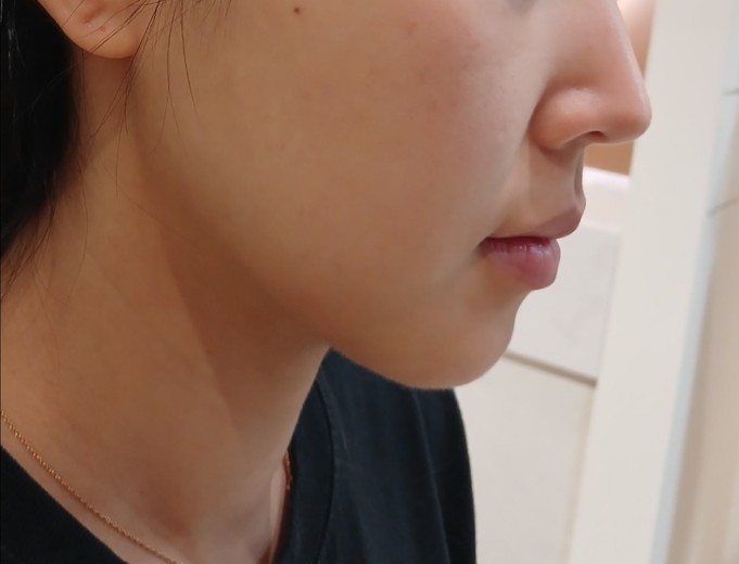 after photo: 인모드리프팅, 윤곽주사