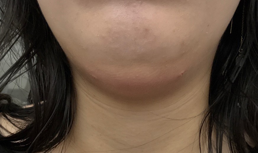 after photo: 脂肪溶解注射(顔)