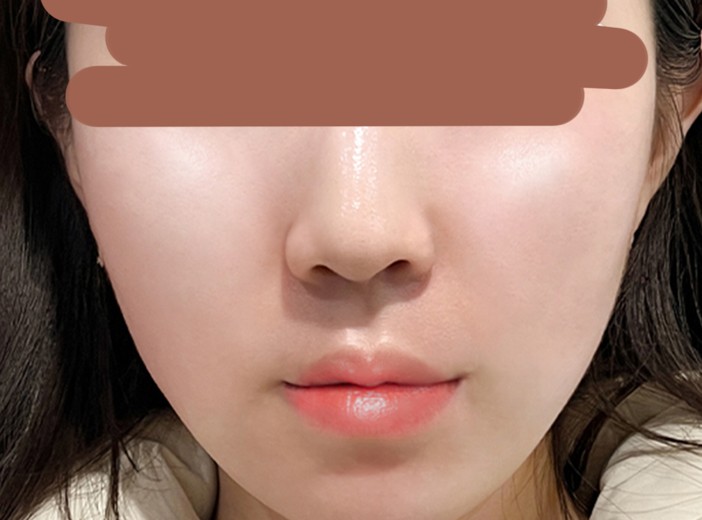 after photo: 팔자주름필러