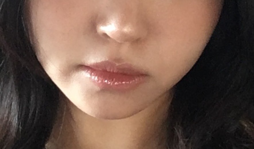 after photo: 윤곽주사, 얼굴지방분해주사