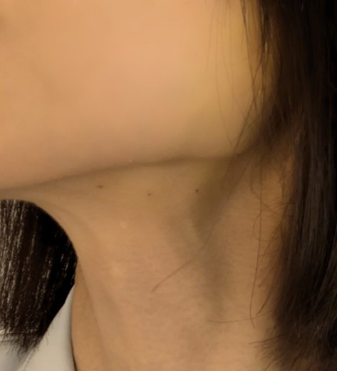 after photo: 糸リフト, メーラー/ジョール/バッカルファット除去