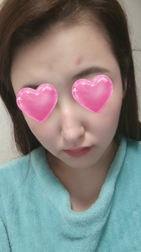 after photo: ピコスポット