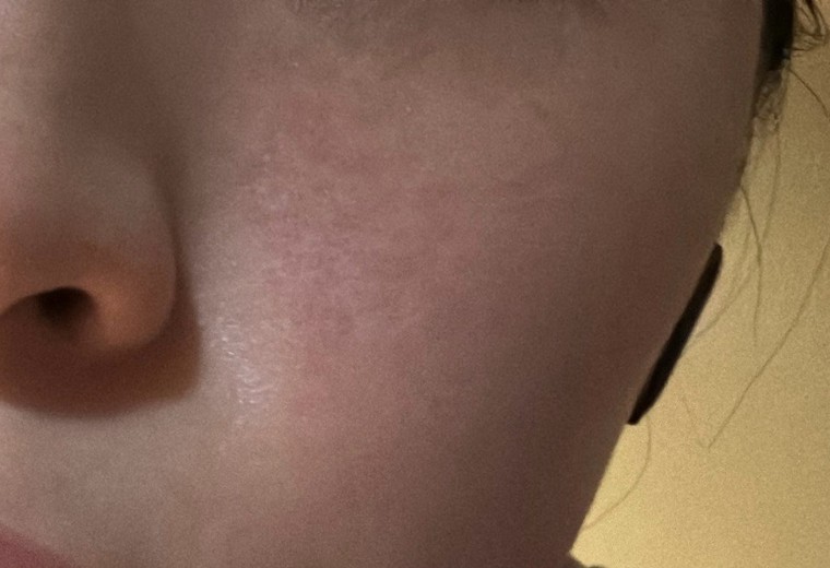 before photo: 水光注射, 診断・検査