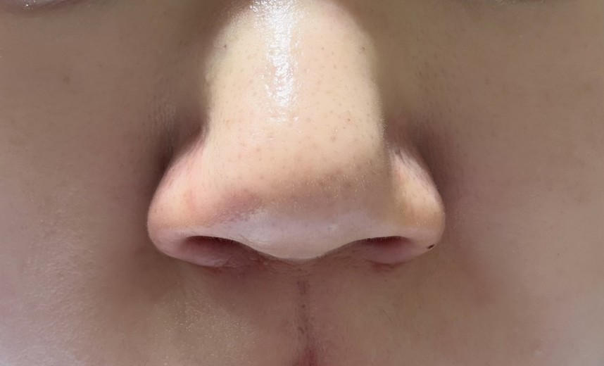 before photo: 小鼻ボトックス, 脂肪溶解注射(顔)