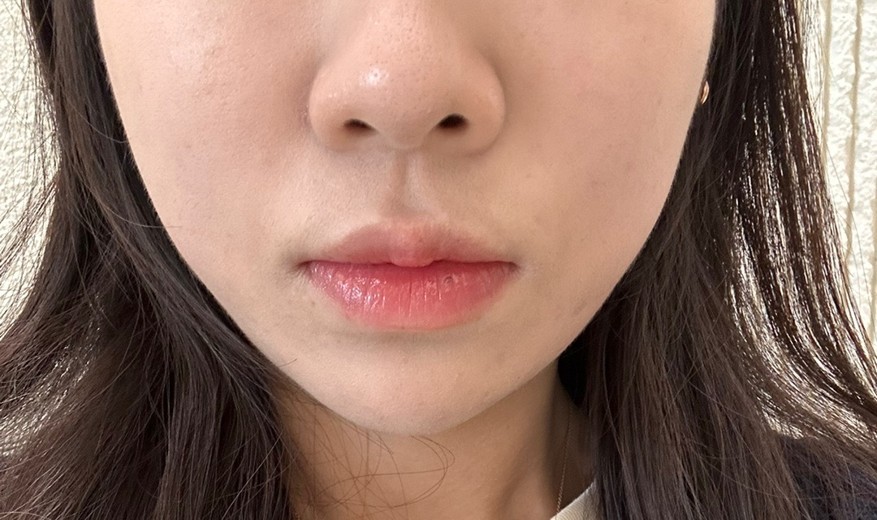 after photo: 티타늄리프팅