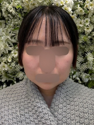 after photo: 脂肪溶解注射(顔)