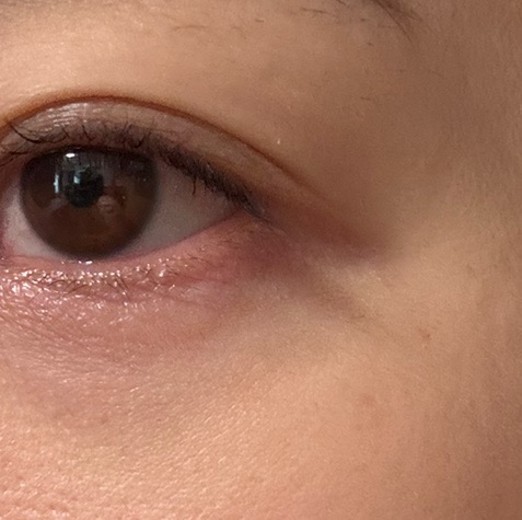after photo: IPL(光/フォト治療), 診断・検査