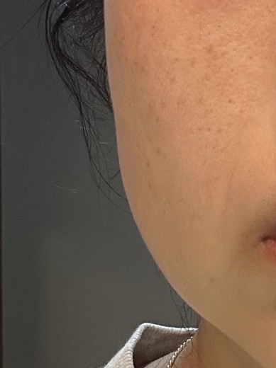 before photo: ピコスポット
