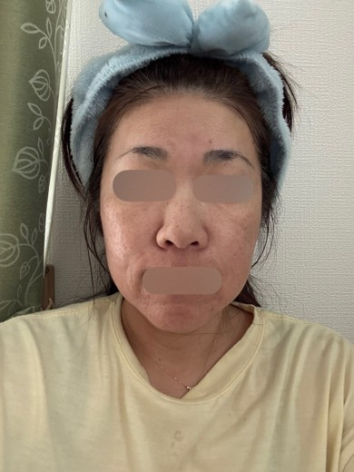 after photo: ヴェルベットスキン