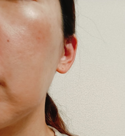 ダーマペン＋リジュラン導入！麻酔代・成長因子パック込【再来OK