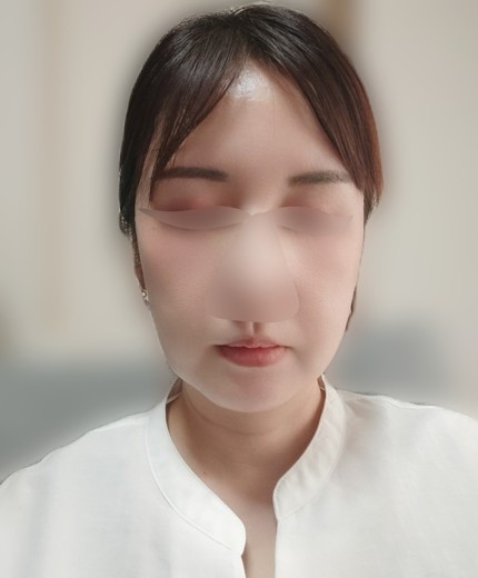 before photo: IPL(光/フォト治療), エレクトロポレーション