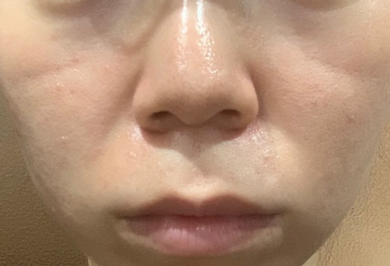 after photo: ダーマペン