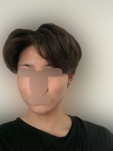 after photo: ダーマペン