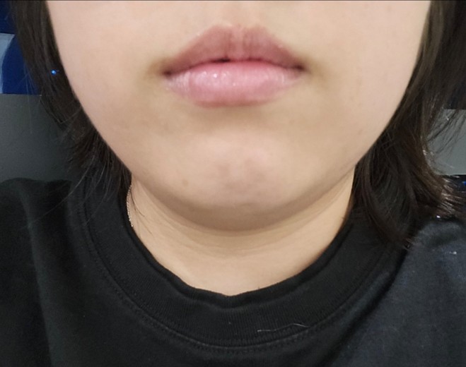 before photo: 사각턱보톡스, 튠라이너