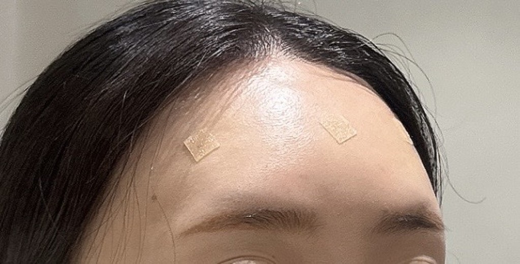 after photo: 이마필러