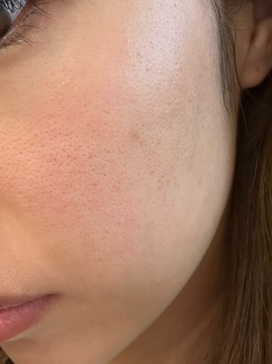 after photo: IPL(光/フォト治療), ルメッカ