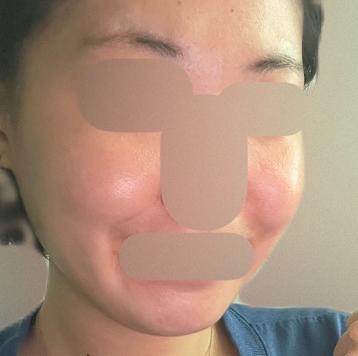 after photo: 인모드리프팅