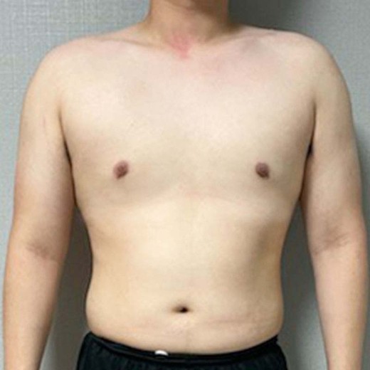 after photo: 여유증수술