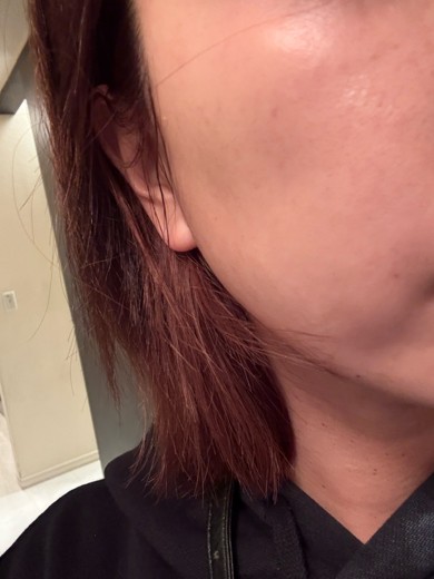 after photo: ハイドラフェイシャル