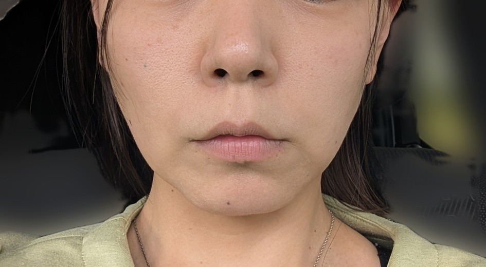after photo: ハイフ(HIFU)