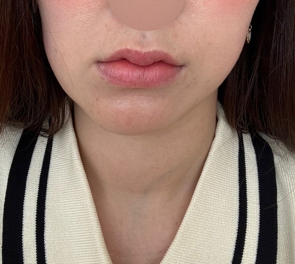 before photo: インモード