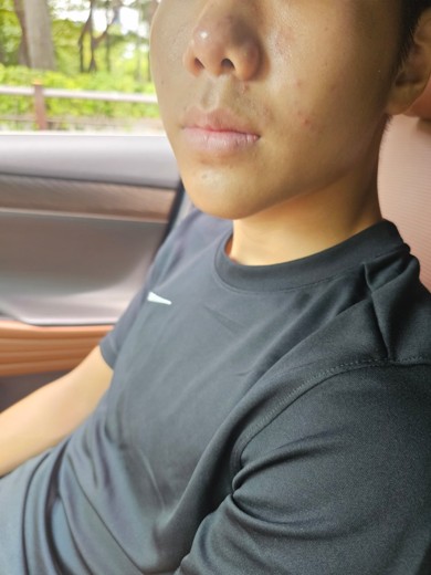 after photo: PDT레이저, 여드름압출