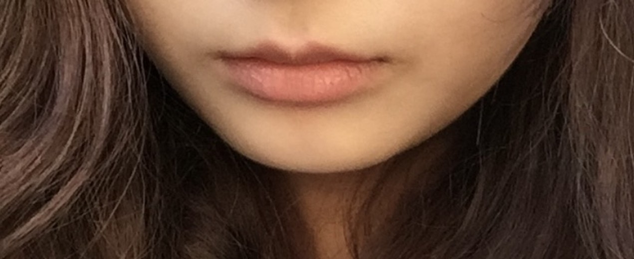 before photo: 입술필러