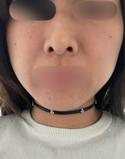 before photo: 脂肪溶解注射(顔)