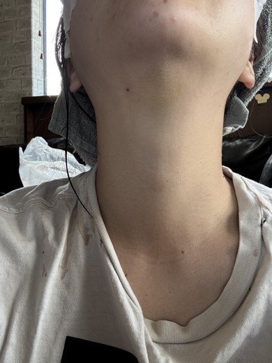 after photo: 脂肪吸引注射