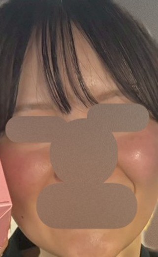 after photo: レーザートーニング