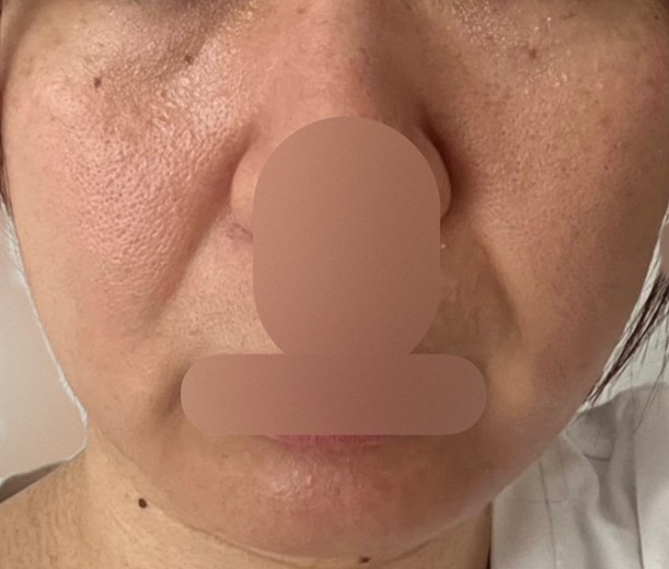 before photo: IPL(光/フォト治療), ピーリング, エレクトロポレーション