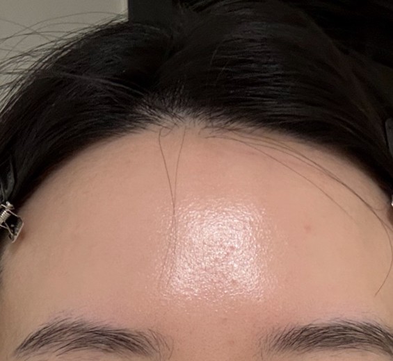 after photo: 턱끝보톡스, 미간보톡스, 눈가주름보톡스