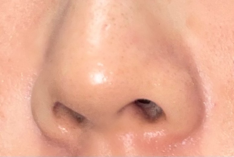 after photo: 脱毛(顔)