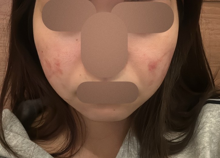 after photo: インモード