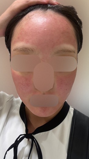 after photo: ダーマペン