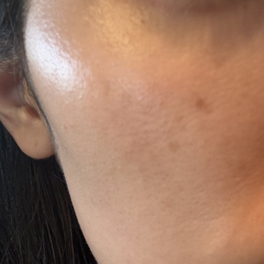 before photo: IPL(光/フォト治療), 診断・検査