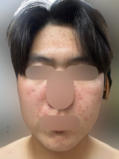 after photo: PRP피부재생술