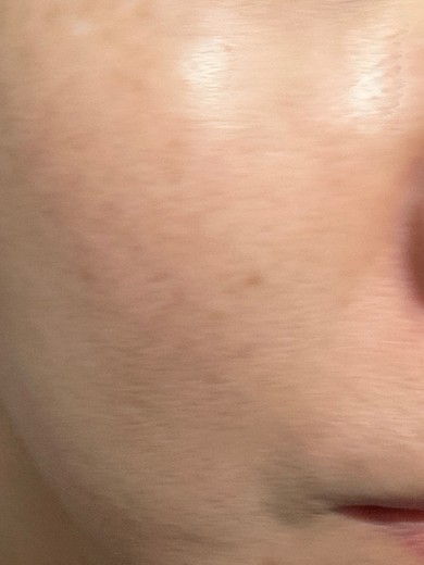 before photo: レーザーフェイシャル