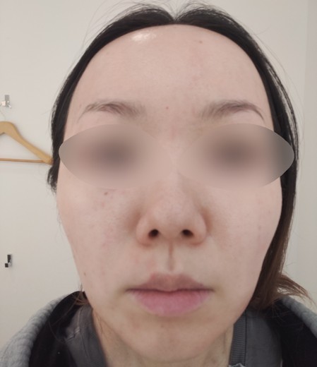 before photo: 水光注射
