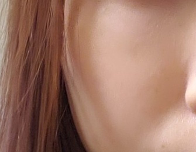 before photo: 白玉注射・点滴