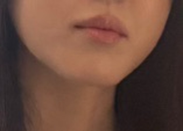 before photo: 윤곽주사, 사각턱보톡스