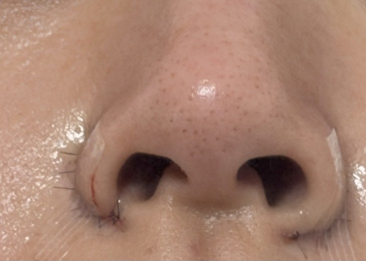 after photo: 콧볼축소